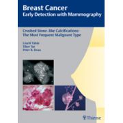 Crushed Stone-like Calcifications: the Most Frequent Malignant Type (Breast Cancer - Early Detection with Mammography)
