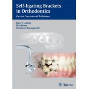 Self-ligating Brackets in Orthodontics: Current Concepts and Techniques