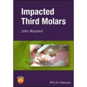 Impacted Third Molars